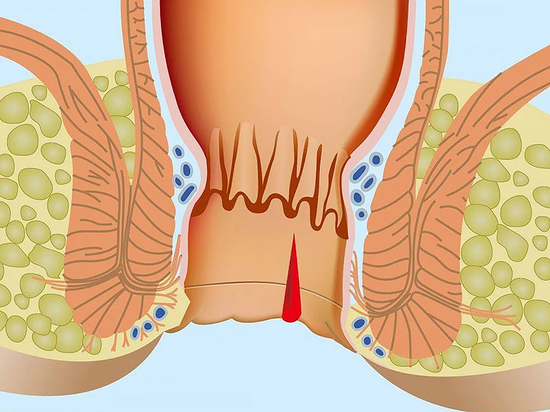 Анальный зуд. Лечение зуда в заднем проходе. | Медицинский дом Odrex